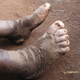 Uno de los casos en Uganda. Christine Kihembo/ASTMH & AJTMH